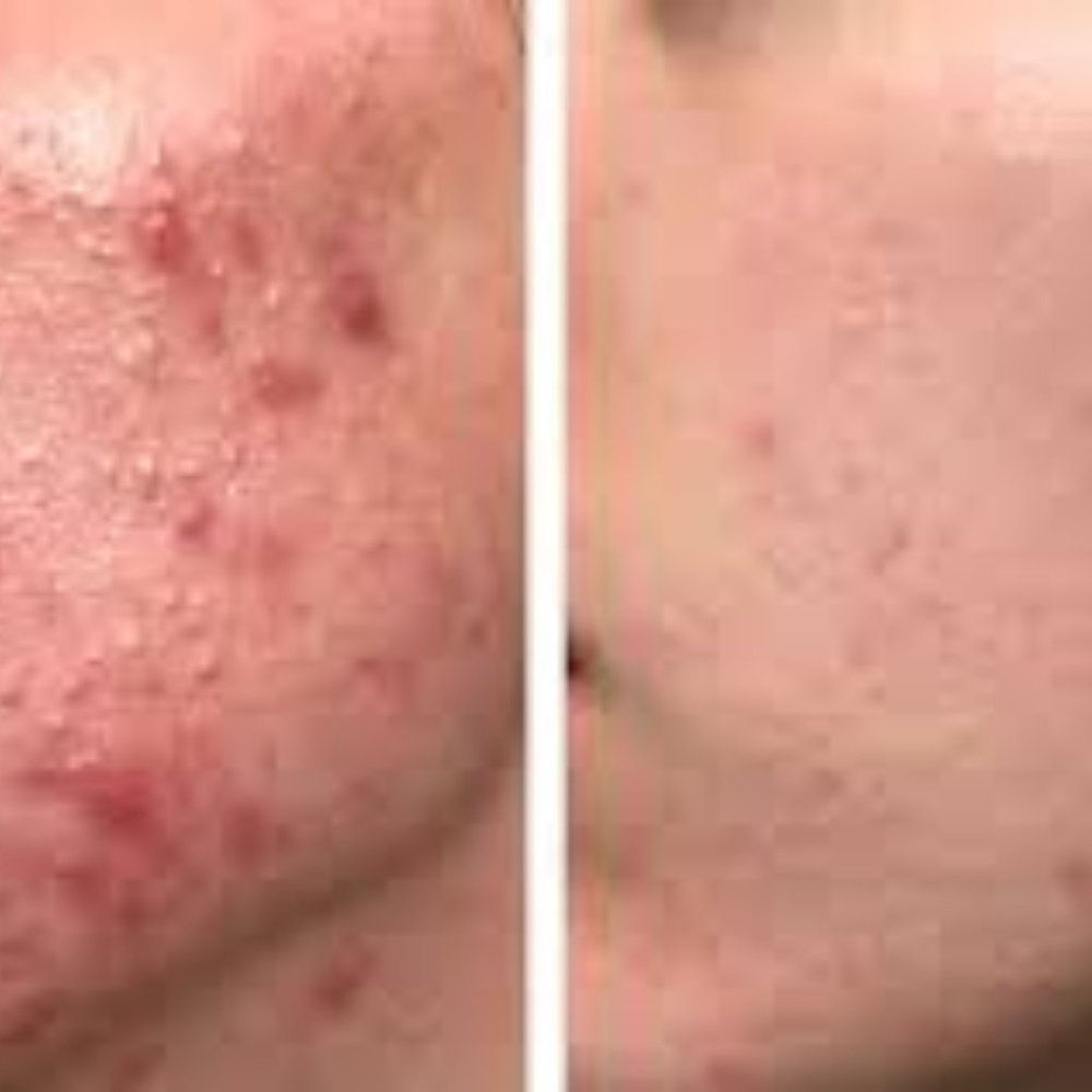 Anti acne serum